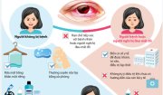 5 khuyến cáo cần biết để phòng chống đau mắt đỏ