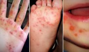 Bệnh chân, tay, miệng là gi? Ai có thể mắc